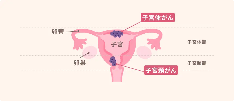 子宮がんの図解。子宮体部にできるのが子宮体がん、子宮頚部にできるのが子宮頸がん